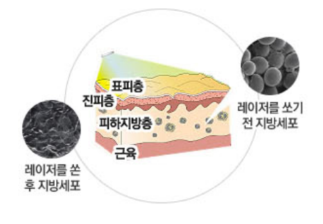 어코니아 레이저